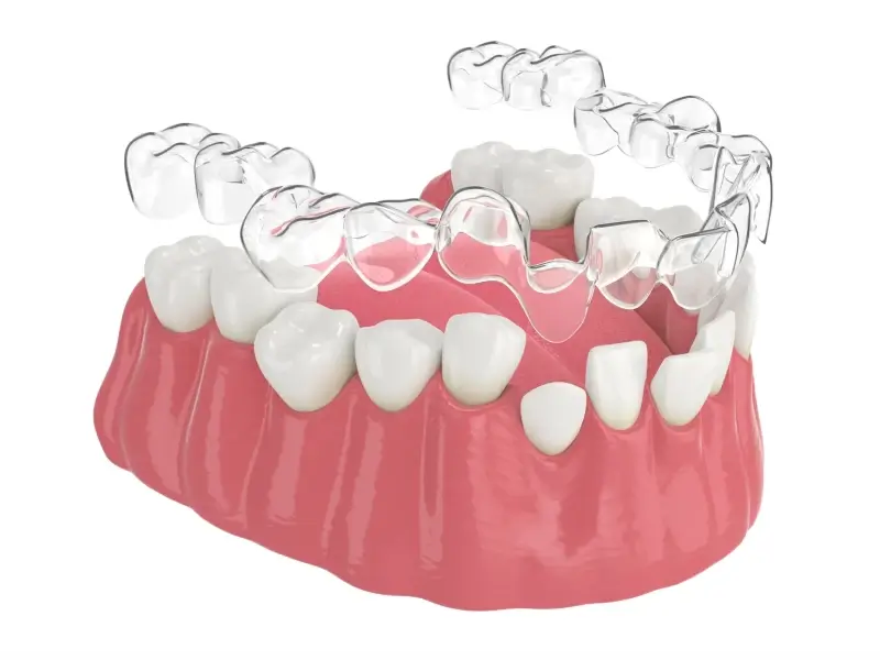 Invisalign dla dzieci
