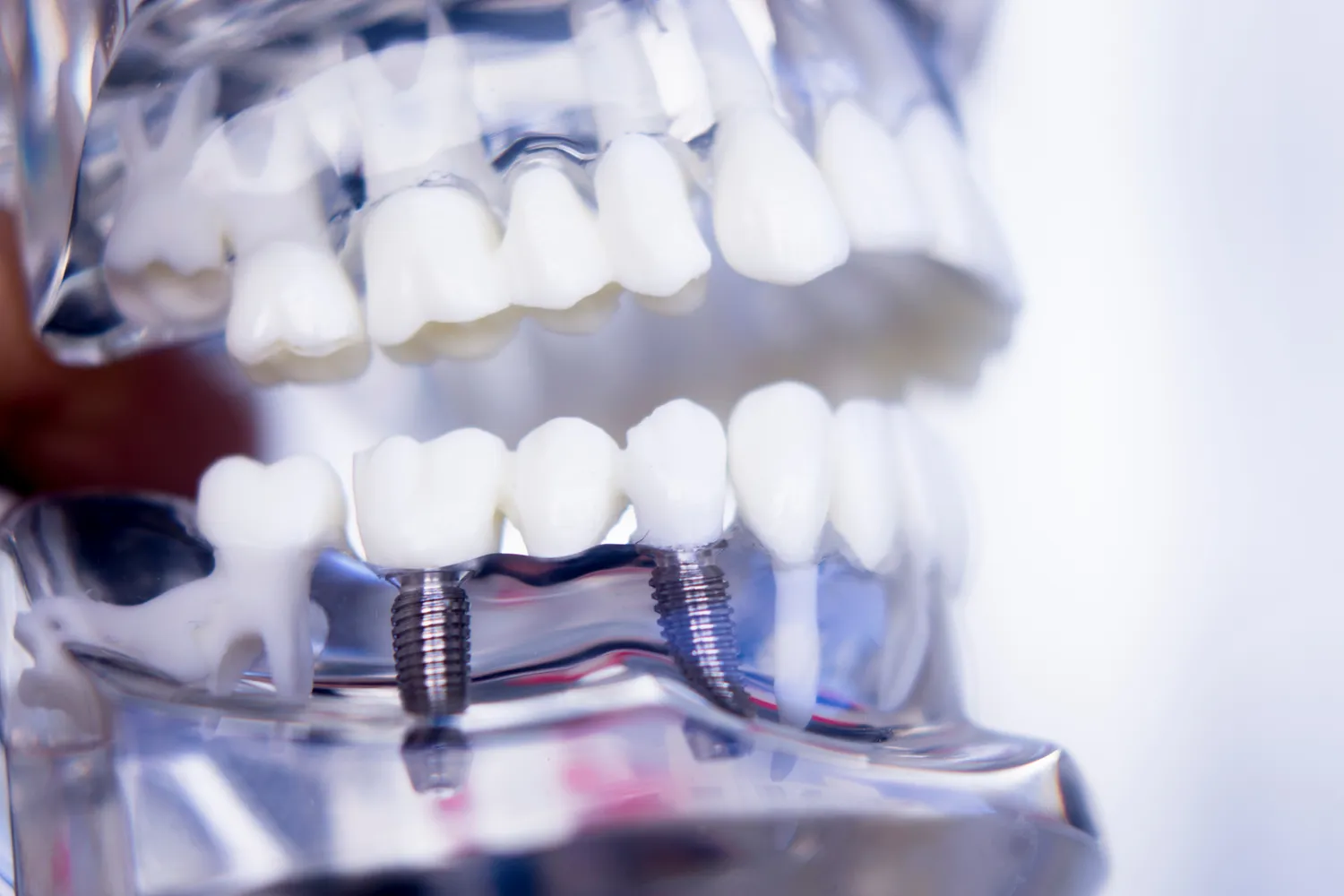 Jak się przygotować do wszczepienia implantów zębów?